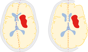 Schematic drawing of hematoma (red) and space-occupying effect before (left) and after decompressive craniectomy (right)