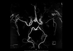 picture showing Stenosis of the middle cerebral artery