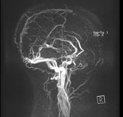 picture showing Thrombosis of sinus sagittal superior