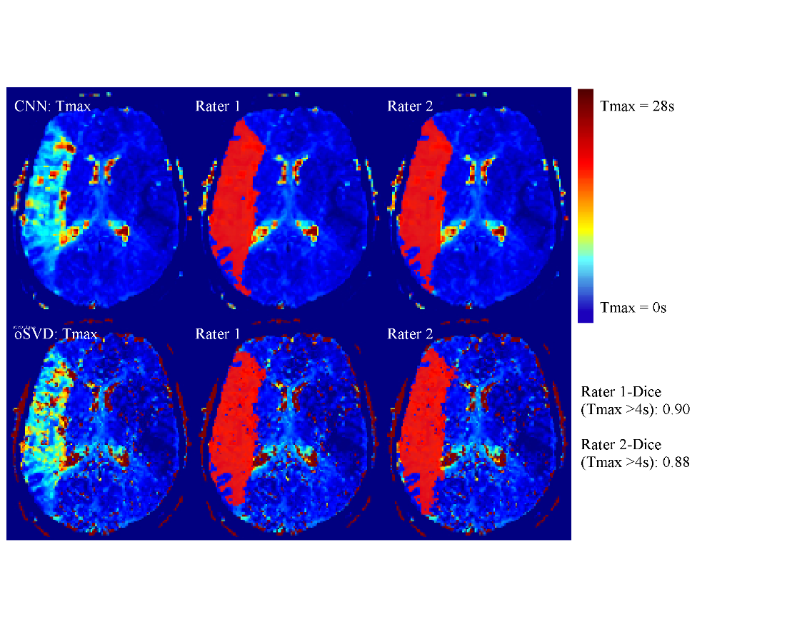 Perfusion maps generated by a neural network (above) and produced by commercial software (below): the two maps were judged by the two raters to have the same value for clinical applications.