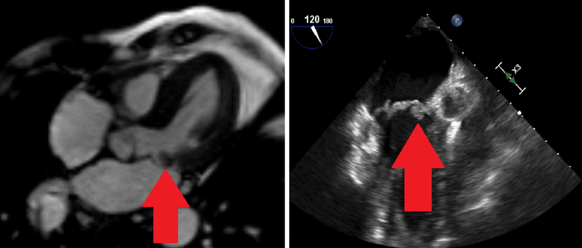 Patient examples of comparison of cardiac MRI and transesophageal echocardiography from the BEHABIS trial. Concordance of CMR and TEE to detect a vegetation of infective endocarditis (red arrow) on the mitral valve as source of embolism in one of the patients with acute ischemic stroke of the BEHABIS trial.