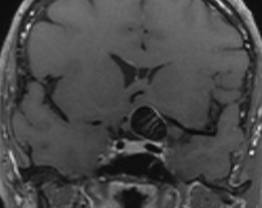 brain scan with an aneurysm